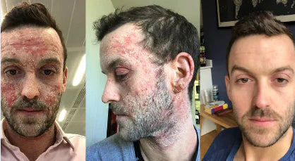 Spray Psoriasis E® TRATAMIENTO ANTIFÚNGICO |Elimina Tiña Inguinal Y Hongos en la Piel